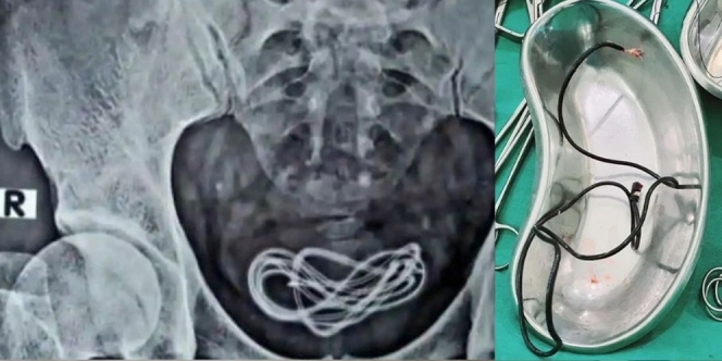 Kabel Charger 60 Cm Nyangkut di Kandung Kemih Dokter Shock Saat Tahu Sebabnya